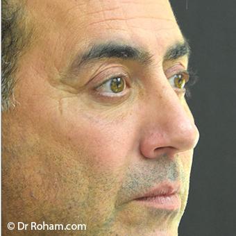 Blepharoplasty Before & After Patient #1372