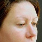 Blepharoplasty Before & After Patient #1341