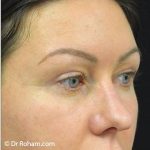Blepharoplasty Before & After Patient #1341