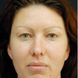 Blepharoplasty Before & After Patient #1341