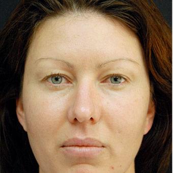 Blepharoplasty Before & After Patient #1341