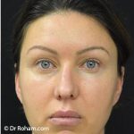 Blepharoplasty Before & After Patient #1341