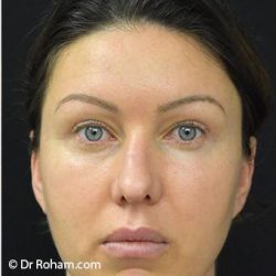 Blepharoplasty Before & After Patient #1341