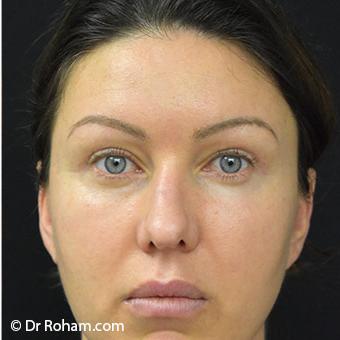Blepharoplasty Before & After Patient #1341