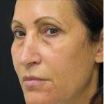 Blepharoplasty Before & After Patient #1344