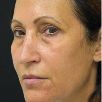 Blepharoplasty Before & After Patient #1344