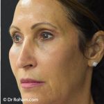 Blepharoplasty Before & After Patient #1344
