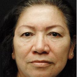 Blepharoplasty Before & After Patient #1345