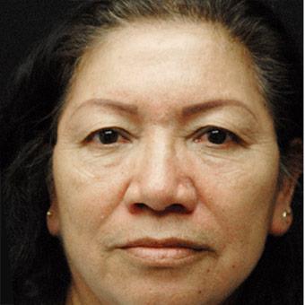 Blepharoplasty Before & After Patient #1345