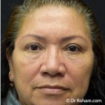 Blepharoplasty Before & After Patient #1345