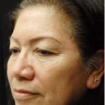 Blepharoplasty Before & After Patient #1345