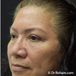 Blepharoplasty Before & After Patient #1345