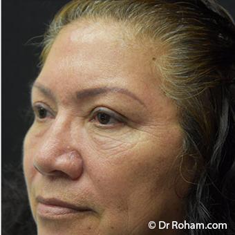 Blepharoplasty Before & After Patient #1345