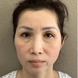 Blepharoplasty Before & After Patient #1346