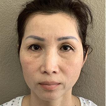Blepharoplasty Before & After Patient #1346
