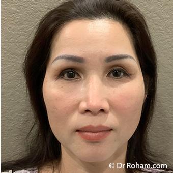 Blepharoplasty Before & After Patient #1346