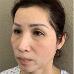 Blepharoplasty Before & After Patient #1346