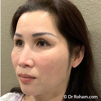 Blepharoplasty Before & After Patient #1346