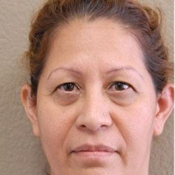 Blepharoplasty Before & After Patient #1347