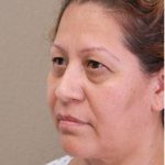 Blepharoplasty Before & After Patient #1347