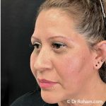 Blepharoplasty Before & After Patient #1347