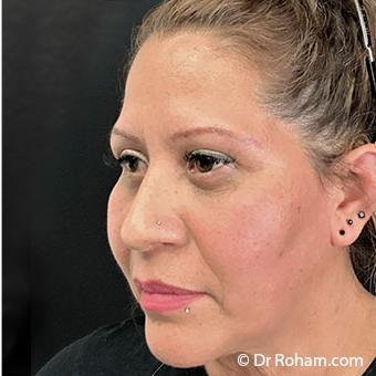 Blepharoplasty Before & After Patient #1347