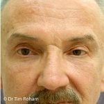 Blepharoplasty Before & After Patient #1348