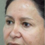 Blepharoplasty Before & After Patient #1349