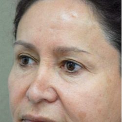 Blepharoplasty Before & After Patient #1349