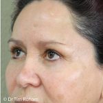 Blepharoplasty Before & After Patient #1349