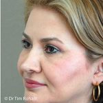 Blepharoplasty Before & After Patient #1350