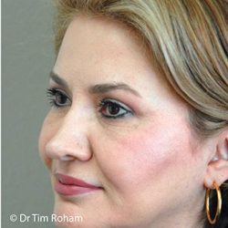 Blepharoplasty Before & After Patient #1350