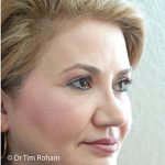 Blepharoplasty Before & After Patient #1350