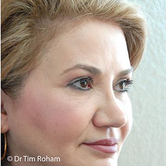 Blepharoplasty Before & After Patient #1350