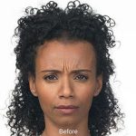 Botox Before & After Patient #1655