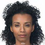 Botox Before & After Patient #1655