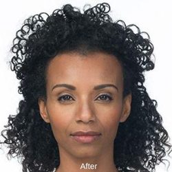Botox Before & After Patient #1655