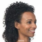 Botox Before & After Patient #1655