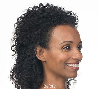 Botox Before & After Patient #1655