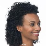 Botox Before & After Patient #1655
