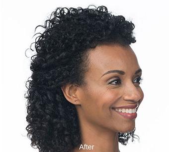 Botox Before & After Patient #1655