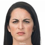 Botox Before & After Patient #1656