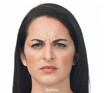 Botox Before & After Patient #1656