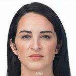 Botox Before & After Patient #1656
