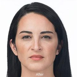 Botox Before & After Patient #1656