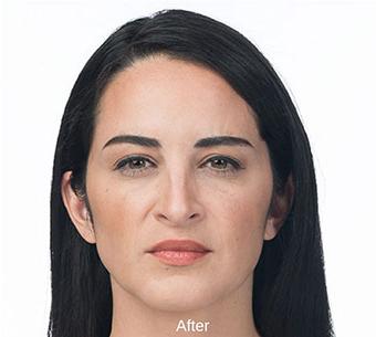 Botox Before & After Patient #1656