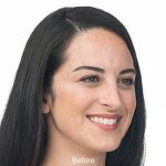 Botox Before & After Patient #1656