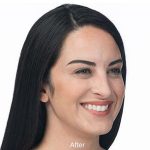 Botox Before & After Patient #1656