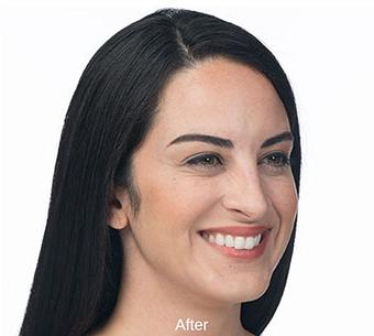 Botox Before & After Patient #1656