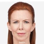 Botox Before & After Patient #1657
